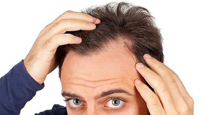 Erkeklerde Genetik Saç Dökülmesi Nasıl Önlenir?